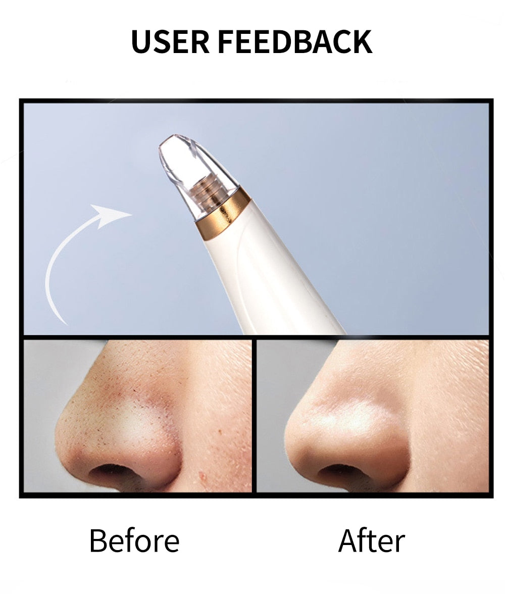 Blackhead Remover Vacuum Suction Deep Pore Facial Cleaning Tool